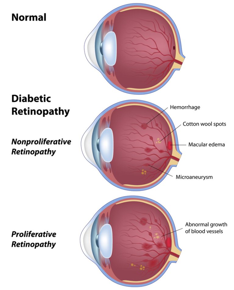 ophthalmologist-jackson-diabetic-retinopathy-mississippi-vision